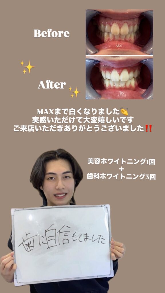 ホワイトニングビフォーアフター